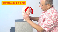 Redness Around the Eyes