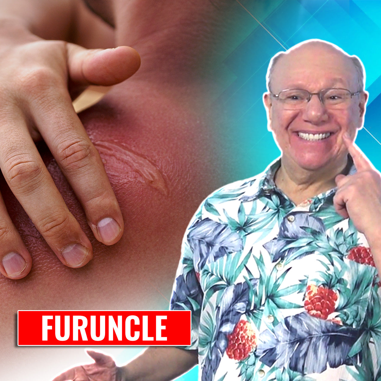 Furuncle Relief – Dr Baritz